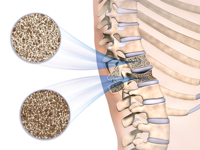 Osteoporosetherapie